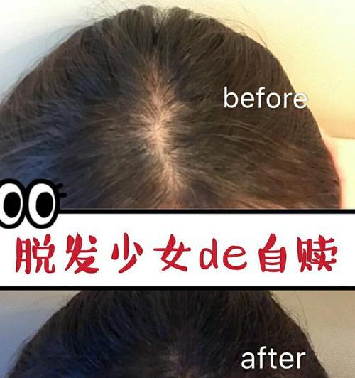 发丝种植方法有哪些？如何正确进行发丝种植？